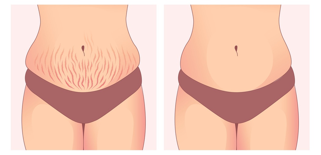 Hamilelik Sonrası Çatlak Tedavisi Paketi